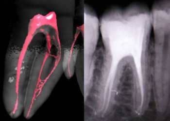 Root_canal_treatment