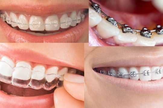 Braces_clips_aligners_dentist