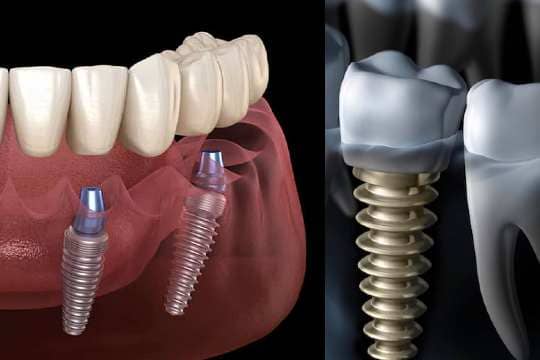 Dental_implant_coimbatore